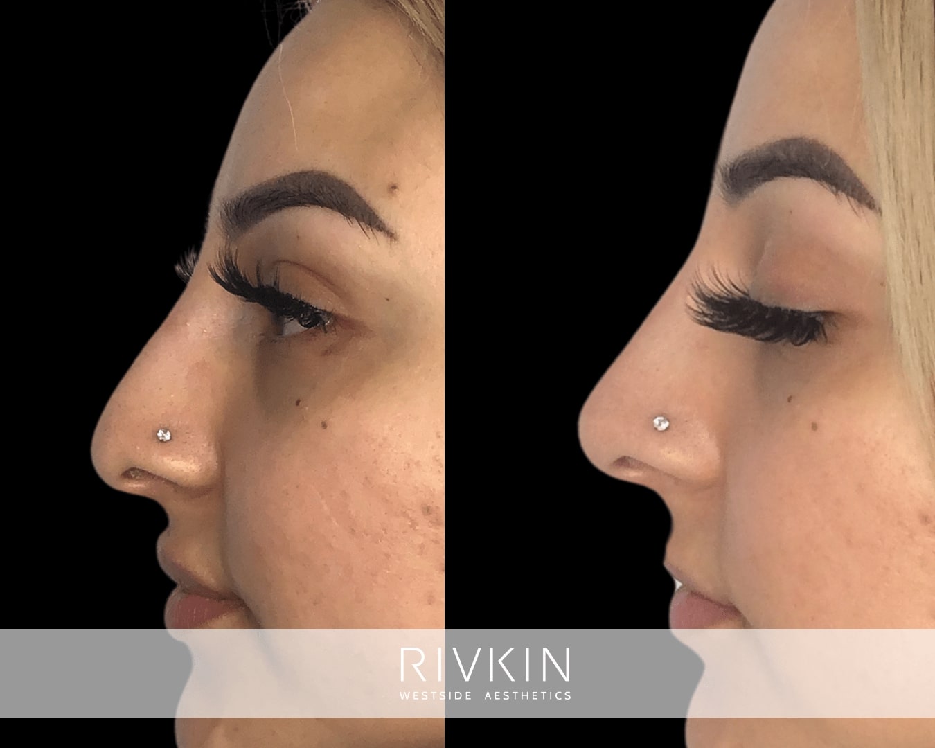 Liquid rhinoplasty lifted this patient's nasal tip improving her side profile, making the nose look more aesthetically pleasing from all angles.