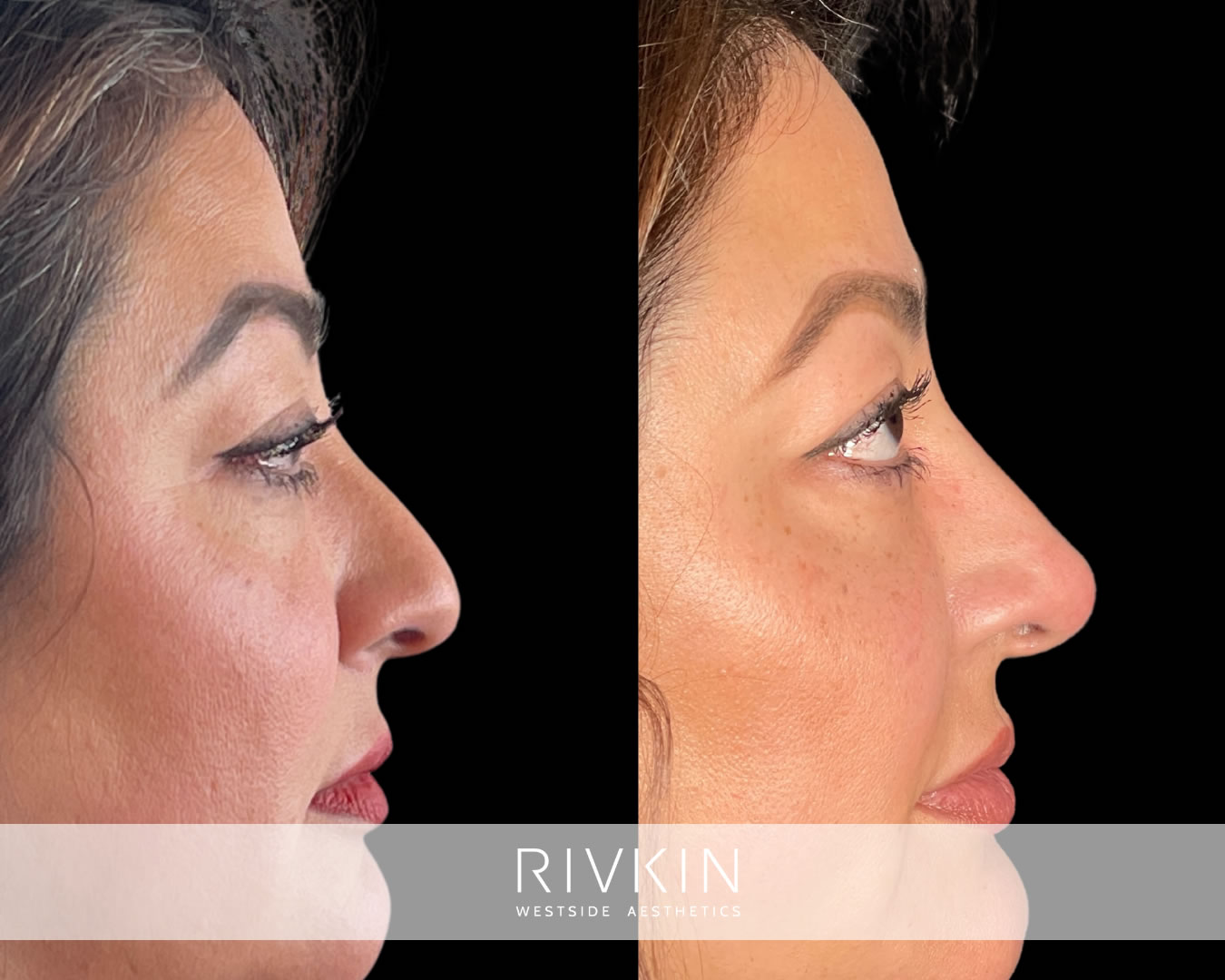 This patient’s droopy nasal tip was elevated solely with Restylane Lyft filler injections. The visible transformation is most noticeable in the profile photo, but the tip projection also appears different from the front view.