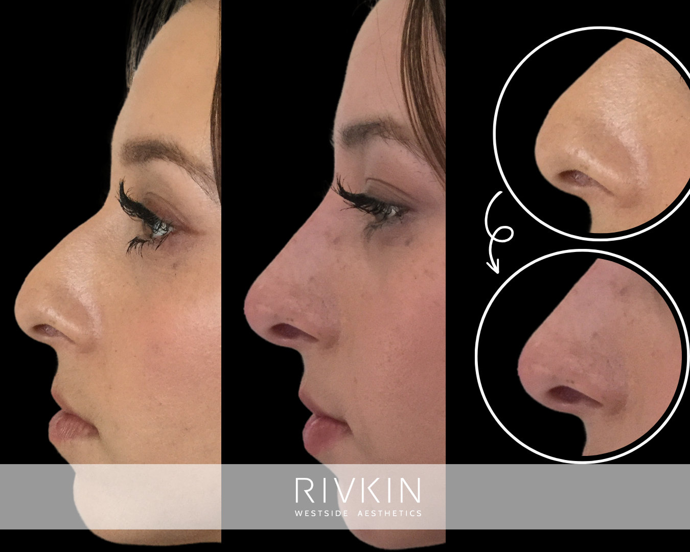 before and after photo of a patient before liquid rhinoplasty