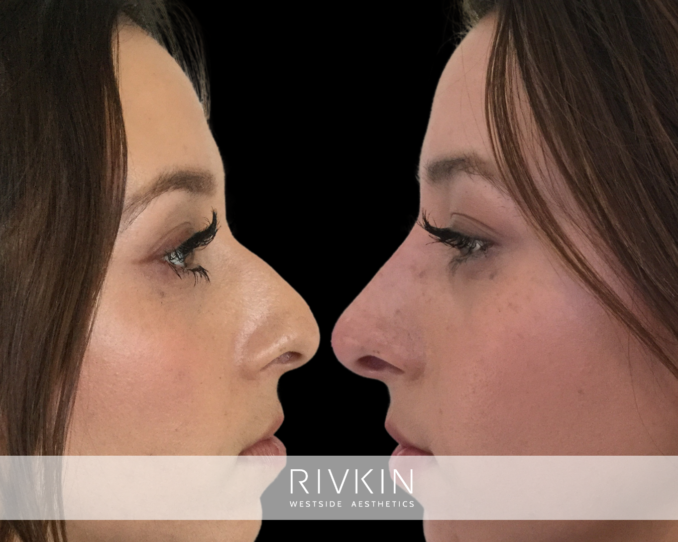 before and after photo of a patient after Liquid rhinoplasty