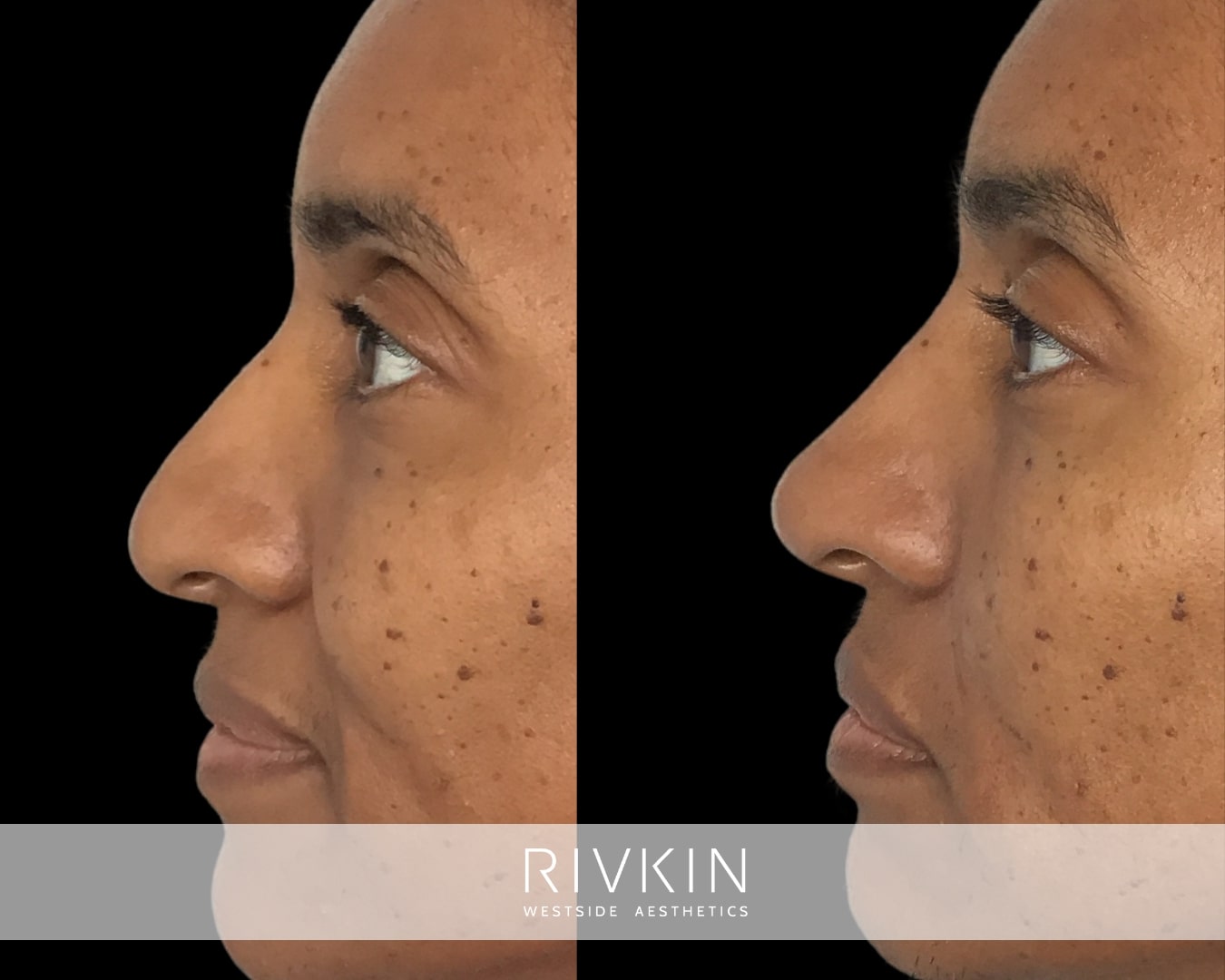 Correcting this patient's tip with nose filler injections made her face appear more youthful and vibrant.