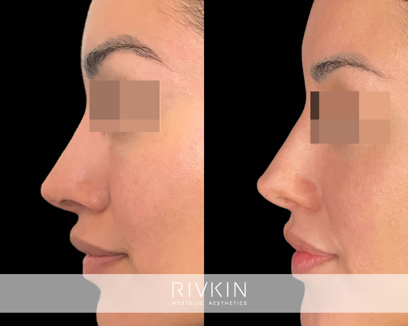 This patient wanted a more perky nose and less prominent nostril openings, so Dr. Rivkin lifted her tip and lowered her nostrils using simple filler injections. Results should last one to one and a half years.