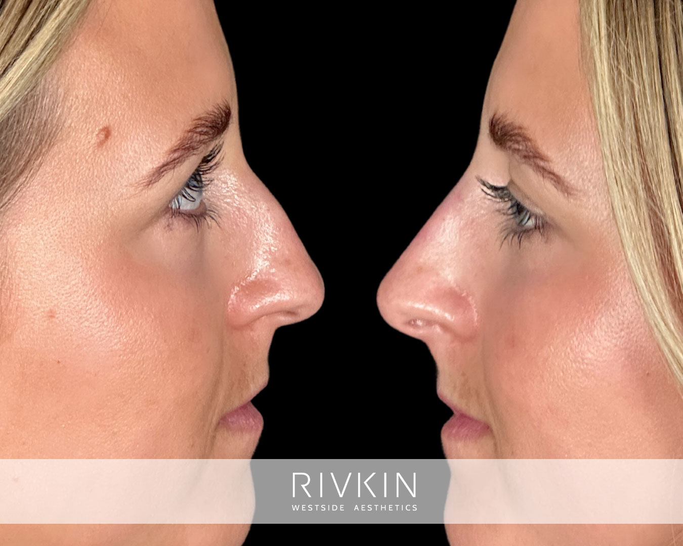 patient before and after liquid rhinoplasty