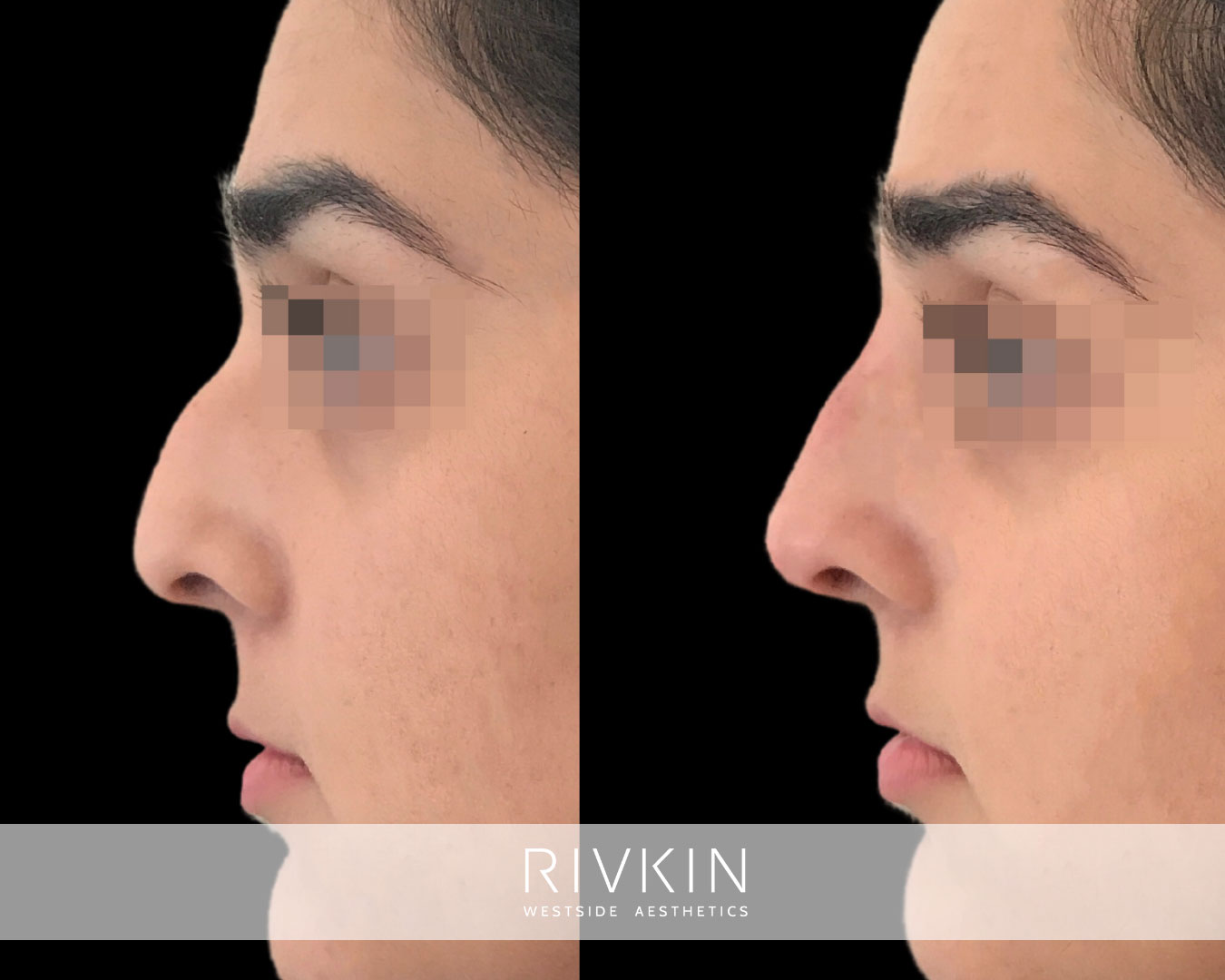 droopy tip, bump, middle eastern nose before and after image