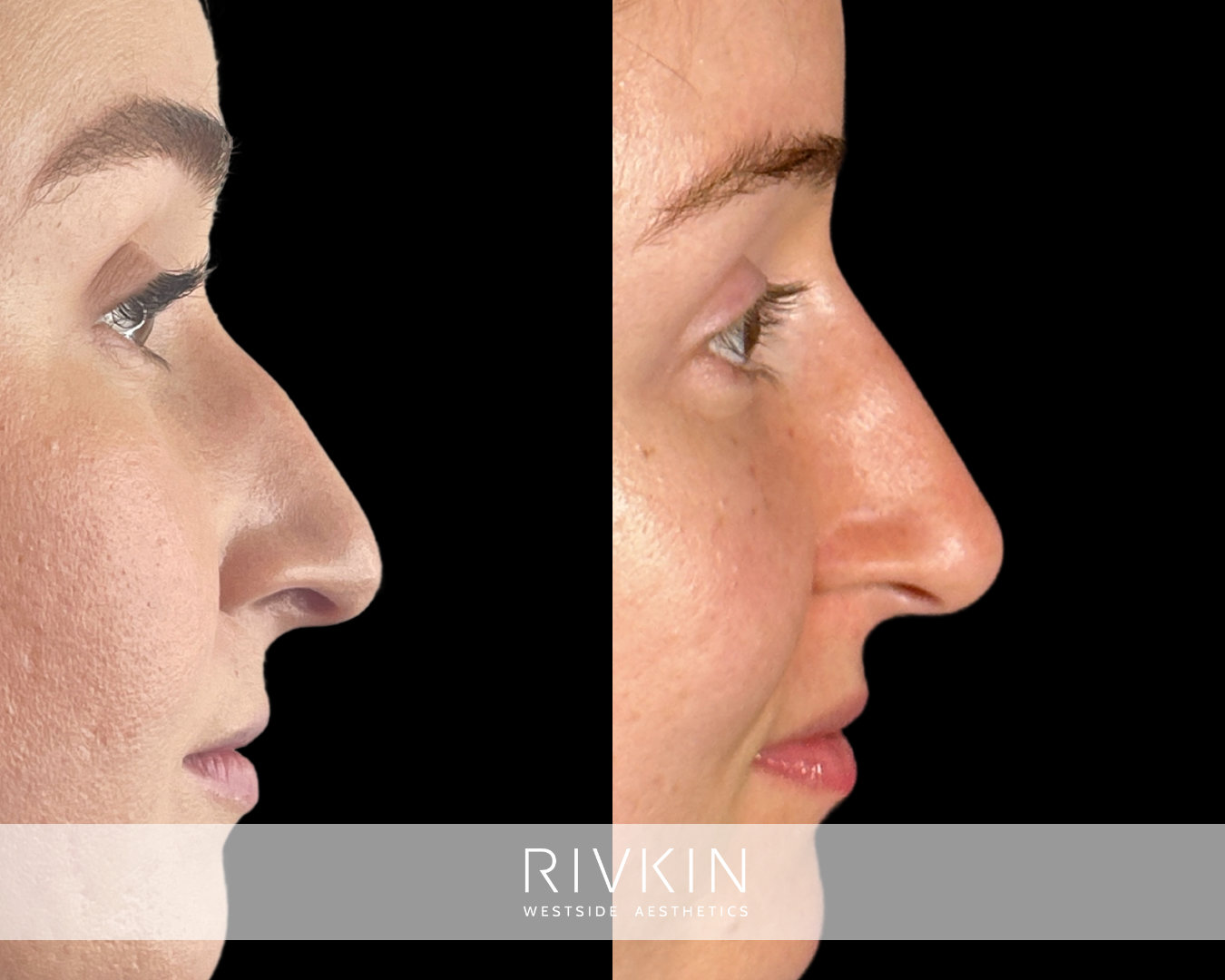 before and after photo of a patient after a complete profile transformation