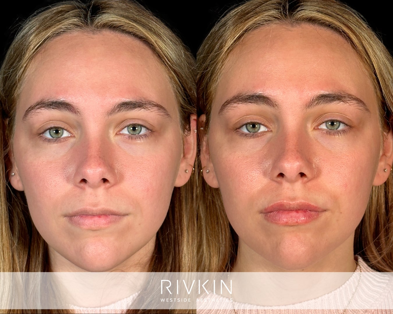 This patient received lip filler treatment in two sessions. She wanted plumper, more hydrated lips that complemented her face, and Nurse Practitioner Presile delivered exactly what she wanted.