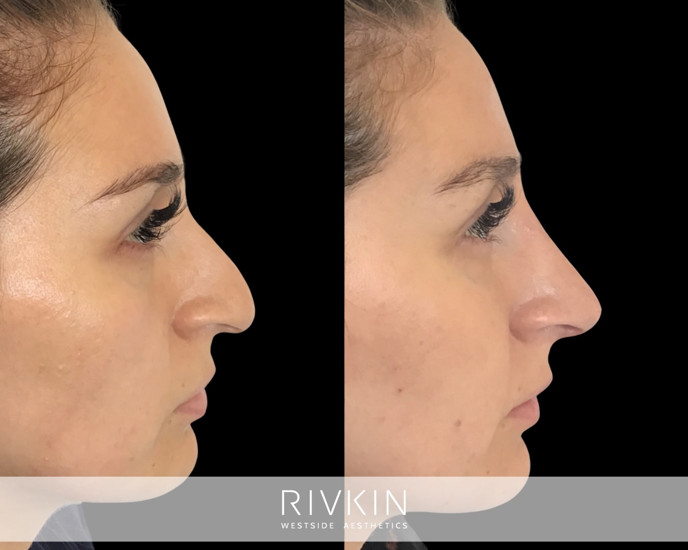 This patient had a nose that drooped down at the tip, making it appear hooked. Dr. Rivkin was able to give her a beautifully straight, and elegant nose using injections of dermal filler. By lifting the tip of her nose, and projecting it forward, her nose now blends in better with the rest of her features.