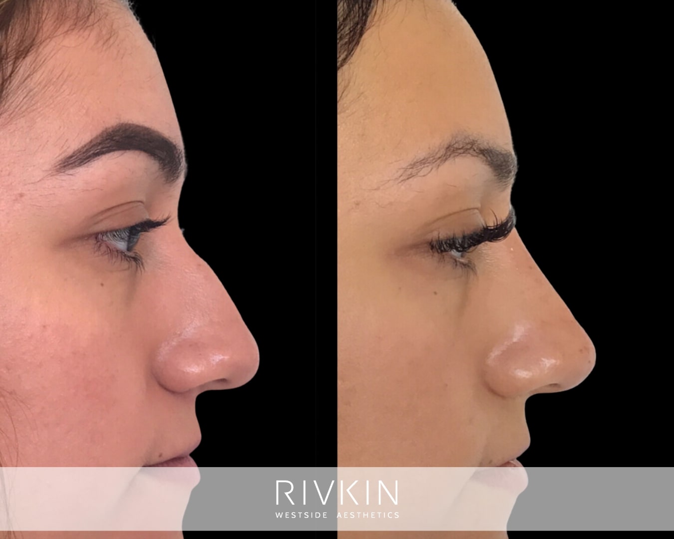 The patient's goal was to achieve a more feminine nose, and Dr. Rivkin accomplished it by straightening her overall profile.