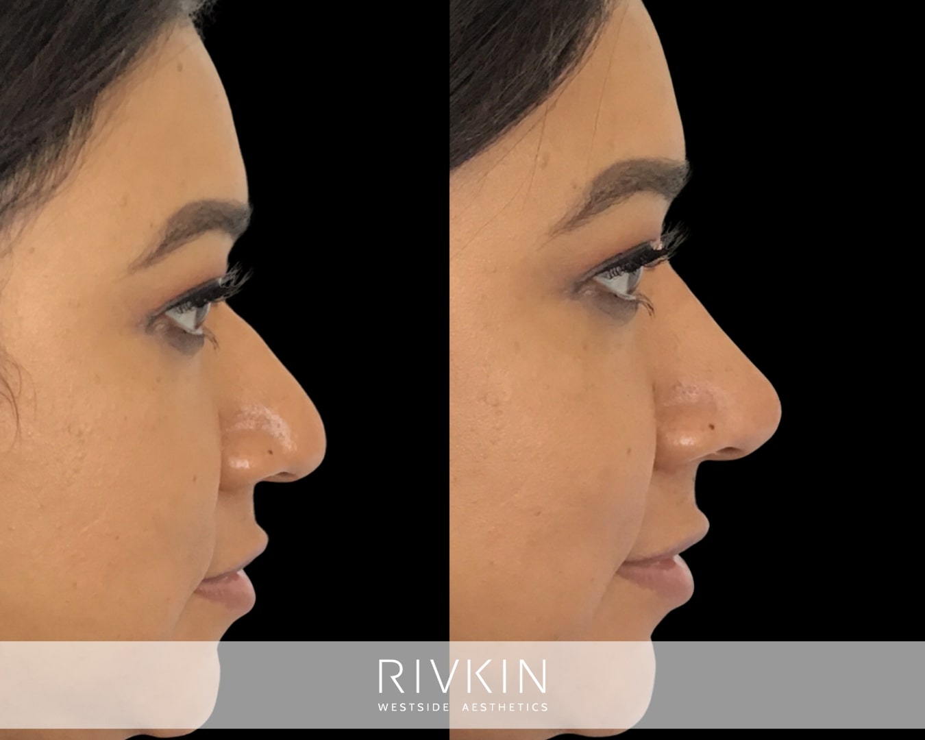 A nose with a rounded tip can be made more pointy using injections of dermal filler. The Non Surgical Nose Job allows patients to make changes to the appearance of their nose, without the risks and downtime of surgery. This patient desired a nose that was more defined, and straighter on the profile.