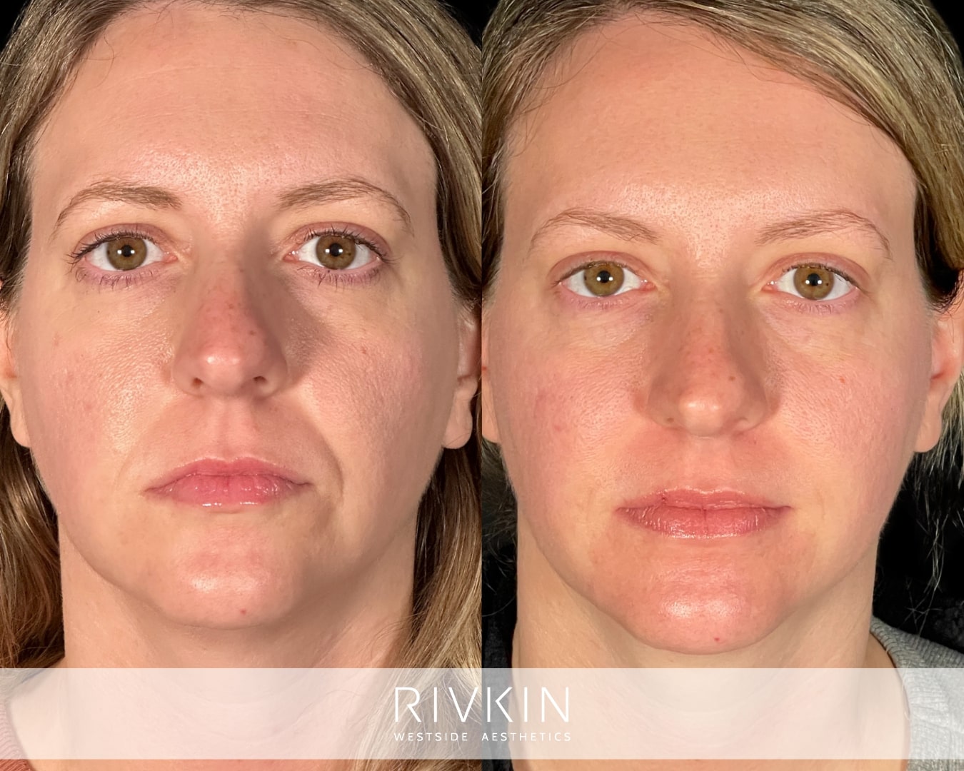 Before and after nasolabial fold filler on this patient in her 30s. Using injections of dermal filler deep lines are smoothed out, revealing a refreshed and youthful appearance.