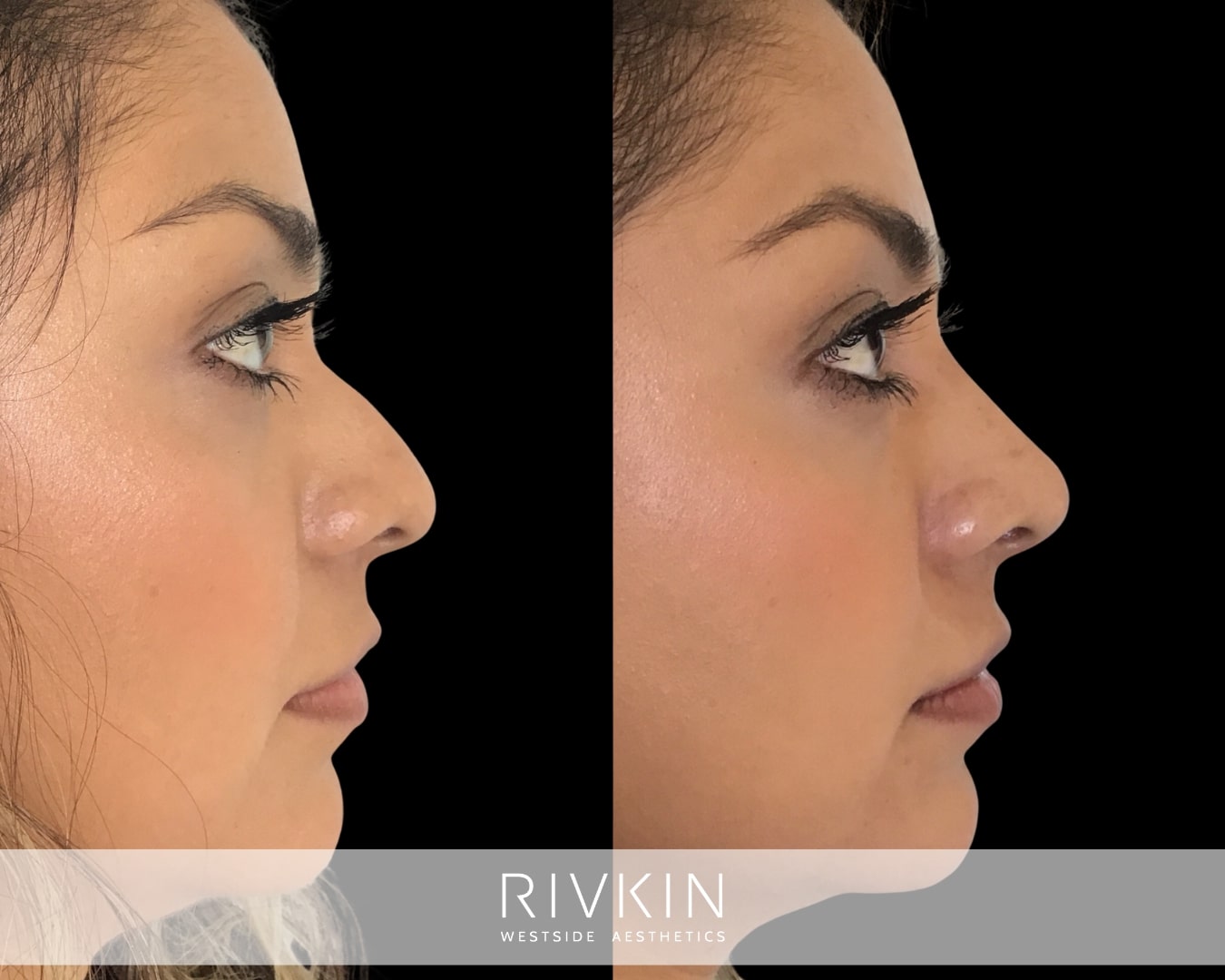 A nose that droops down at the tip gives the illusion of a nose that's larger than it actually is. By projecting the tip forward, and camouflaging the small bump on the bridge, Dr. Rivkin made her nose look smaller and in better harmony with the rest of her face.