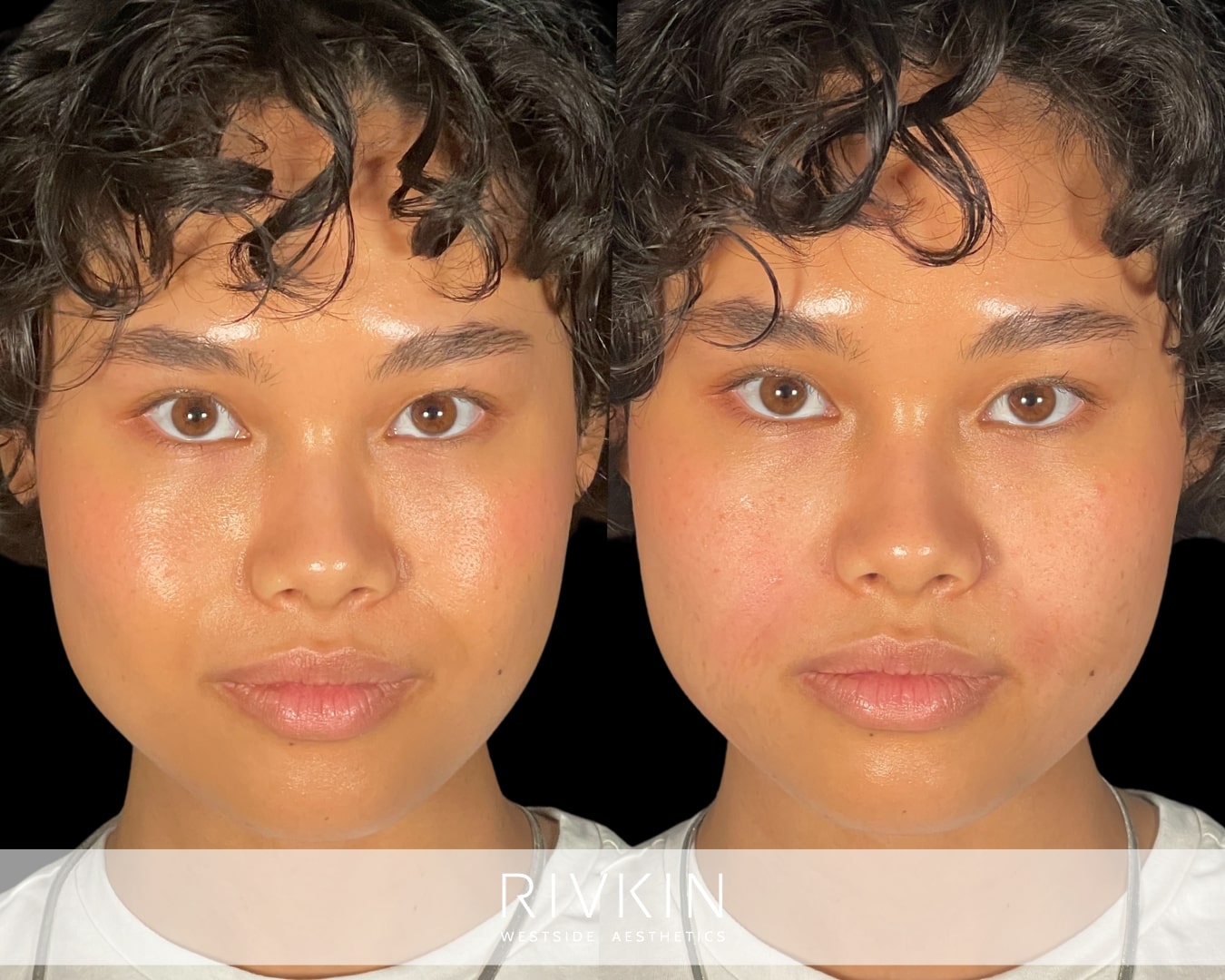 This young patient was bothered by her nasolabial folds, and Nurse Practitioner Presile addressed this with filler injections. She used a very conservative amount of filler to ensure the patient's lower face retained a natural appearance.
