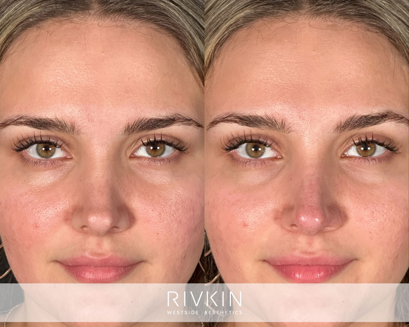 patient before and after surgical rhinoplasty