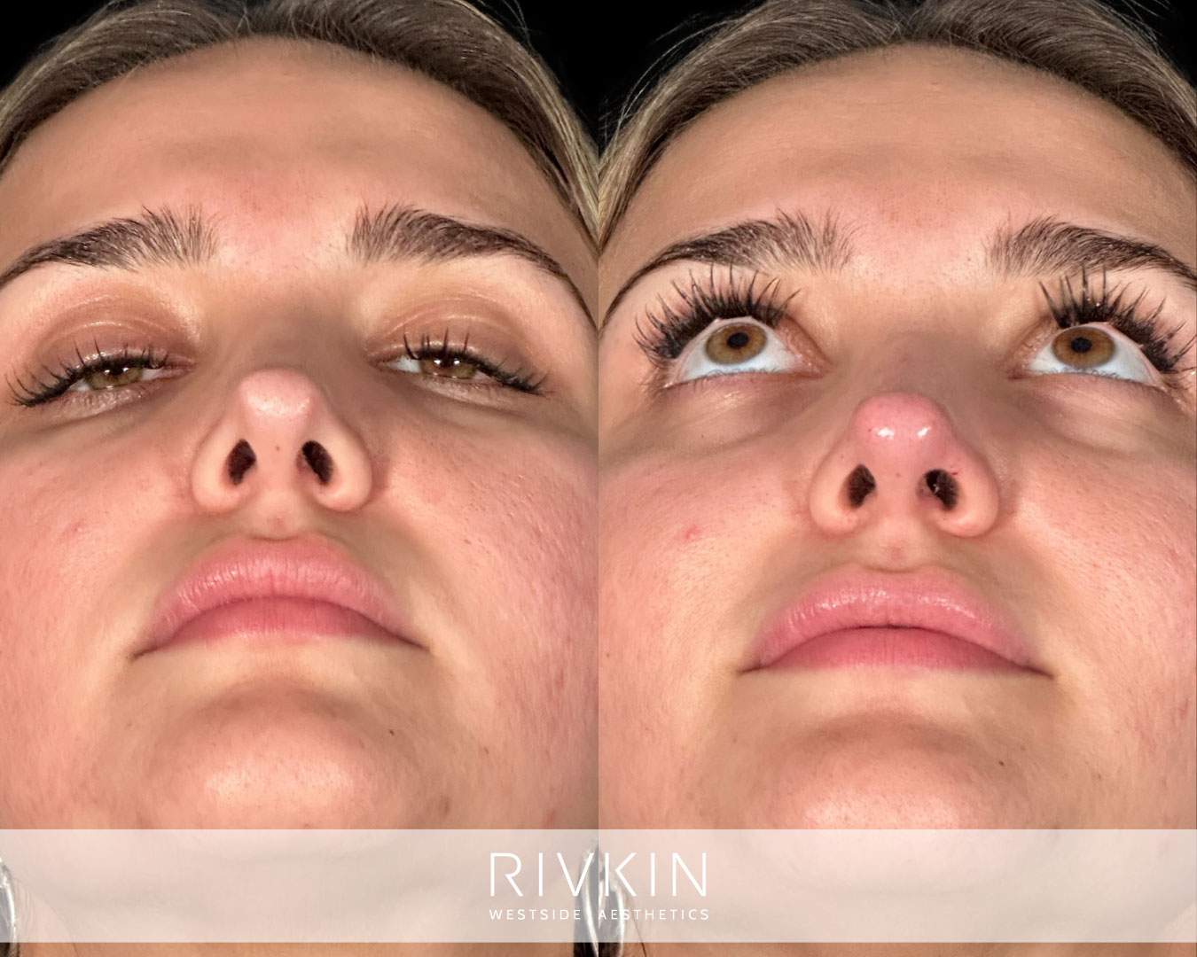 patient before and after surgical rhinoplasty