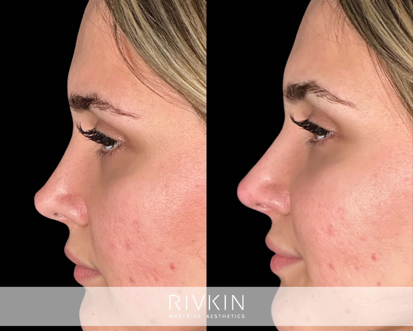 patient before and after surgical rhinoplasty