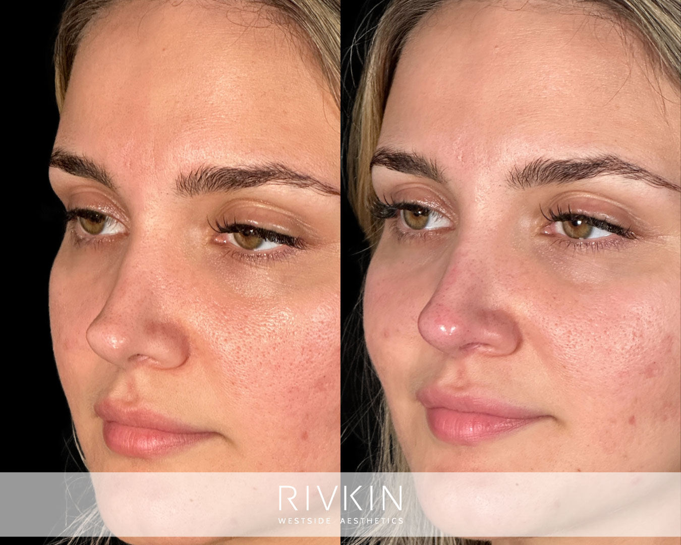 patient before and after surgical rhinoplasty