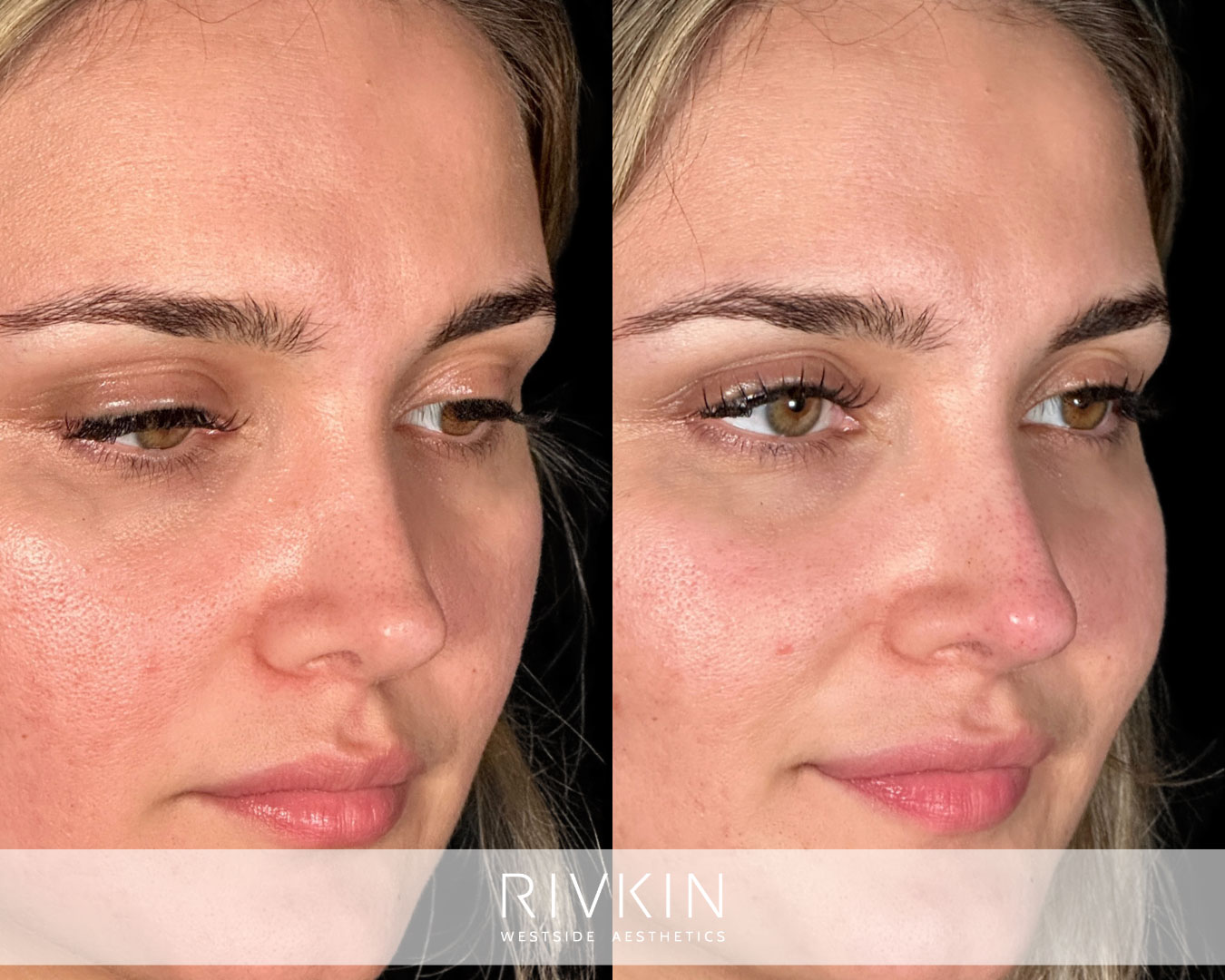 patient before and after surgical rhinoplasty