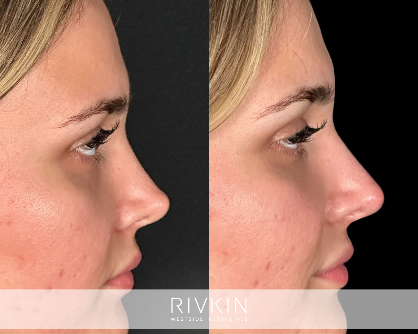 patient before and after surgical rhinoplasty