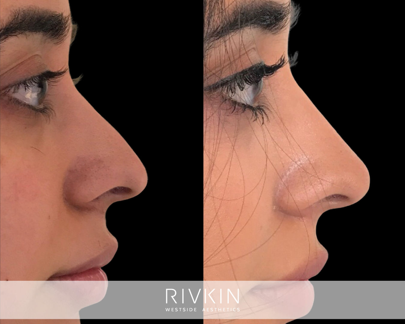 patient before and after middle eastern nose surgery