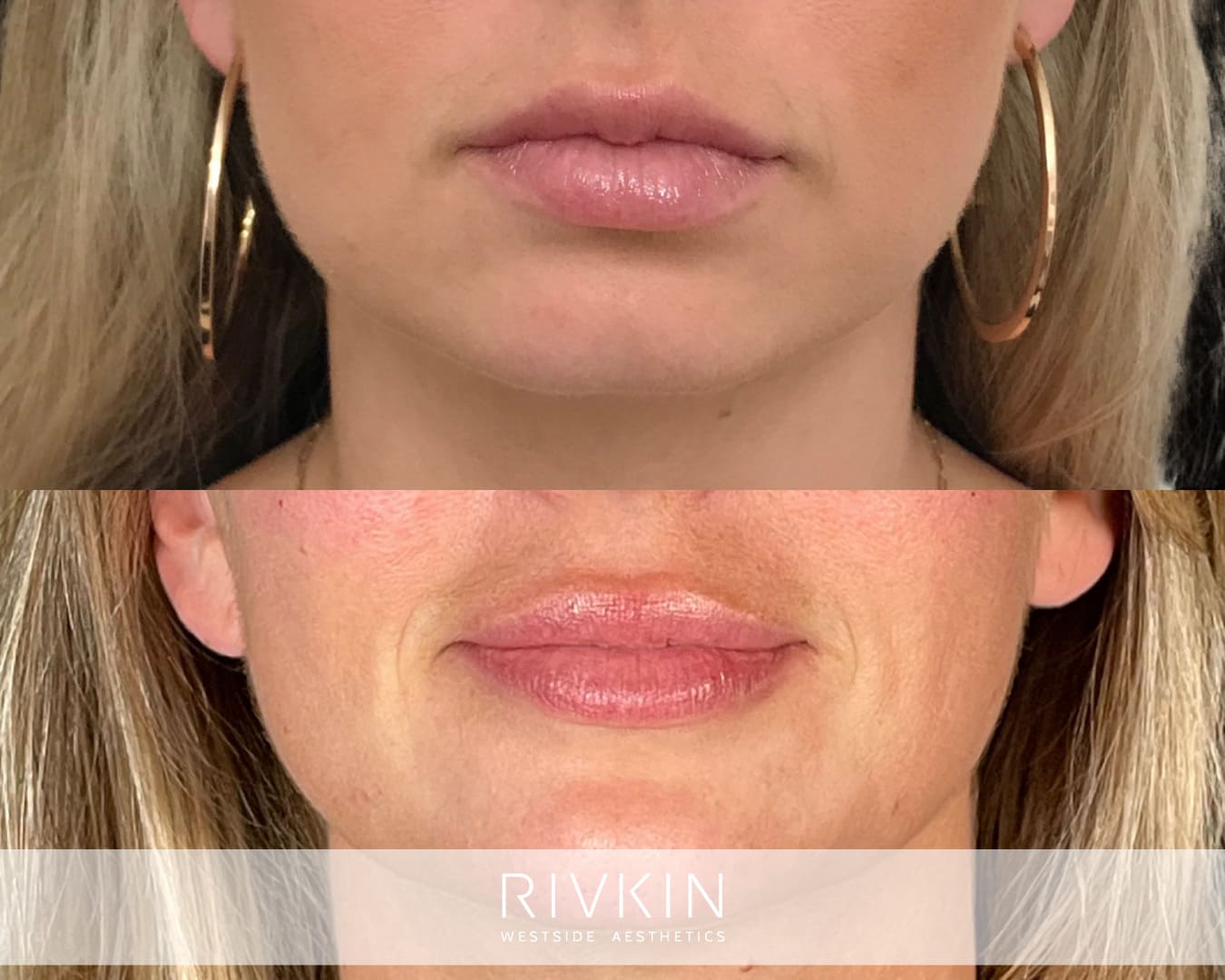 Full, and natural looking lips can be achieved when done by a skilled injector. These pouty lips were achieved over several sessions using Juvederm Vollure.