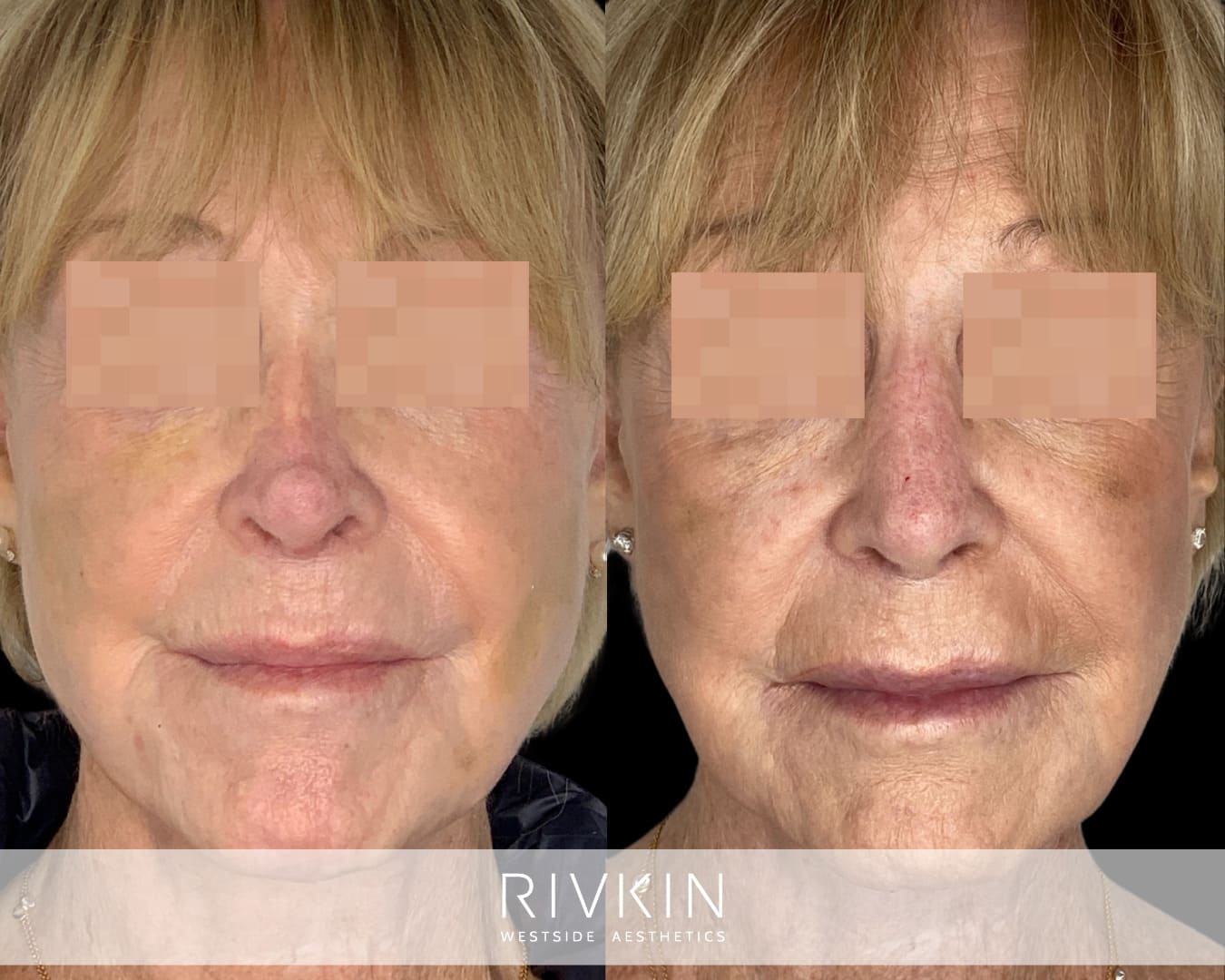 patient before and after revision rhinoplasty