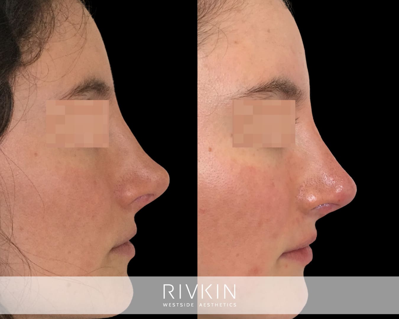 patient before and after revision rhinoplasty