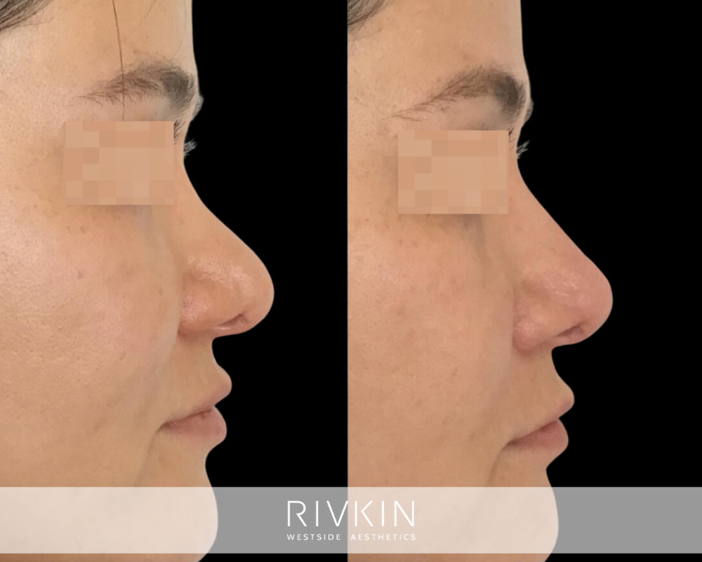 patient before and after revision rhinoplasty