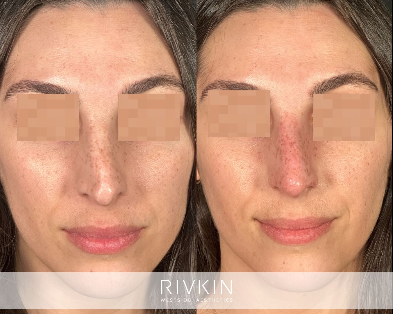 before and after rhinoplasty procedure