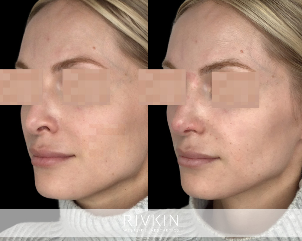 patient before and after revision rhinoplasty