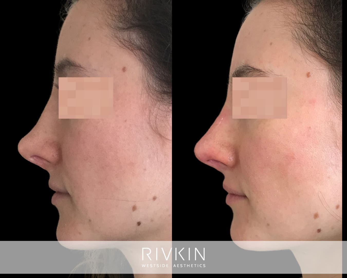 patient before and after revision rhinoplasty