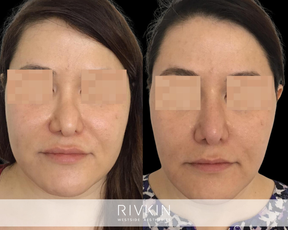 patient before and after revision rhinoplasty