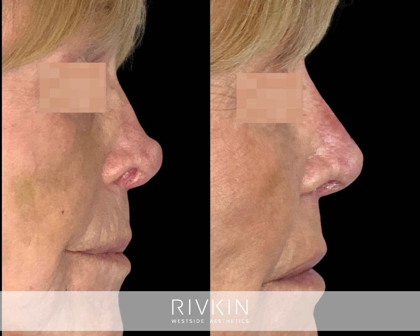 patient before and after revision rhinoplasty