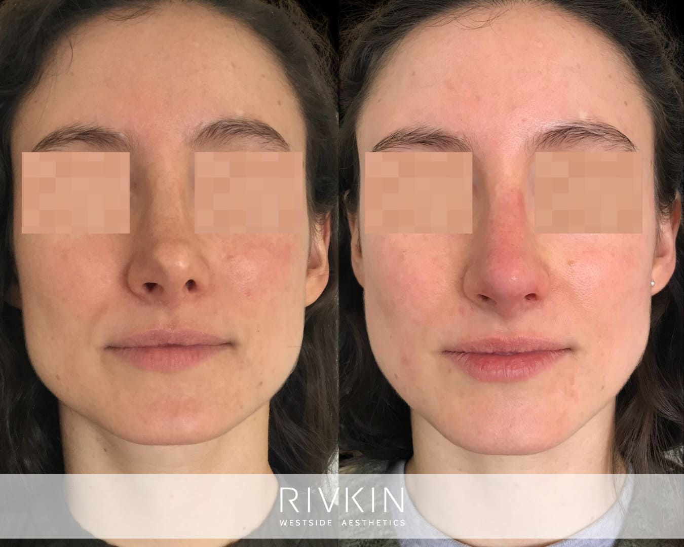 patient before and after revision rhinoplasty