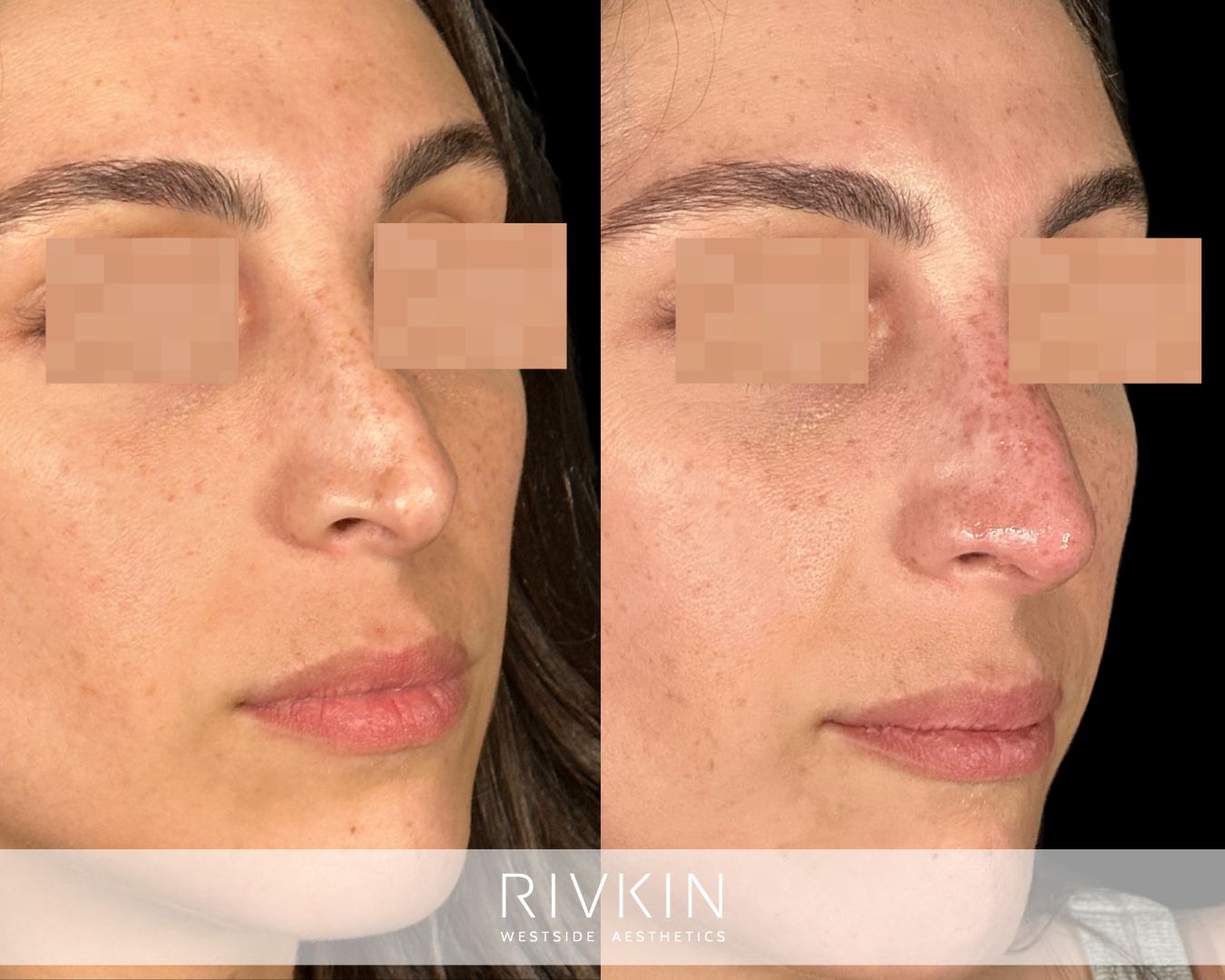 before and after rhinoplasty procedure