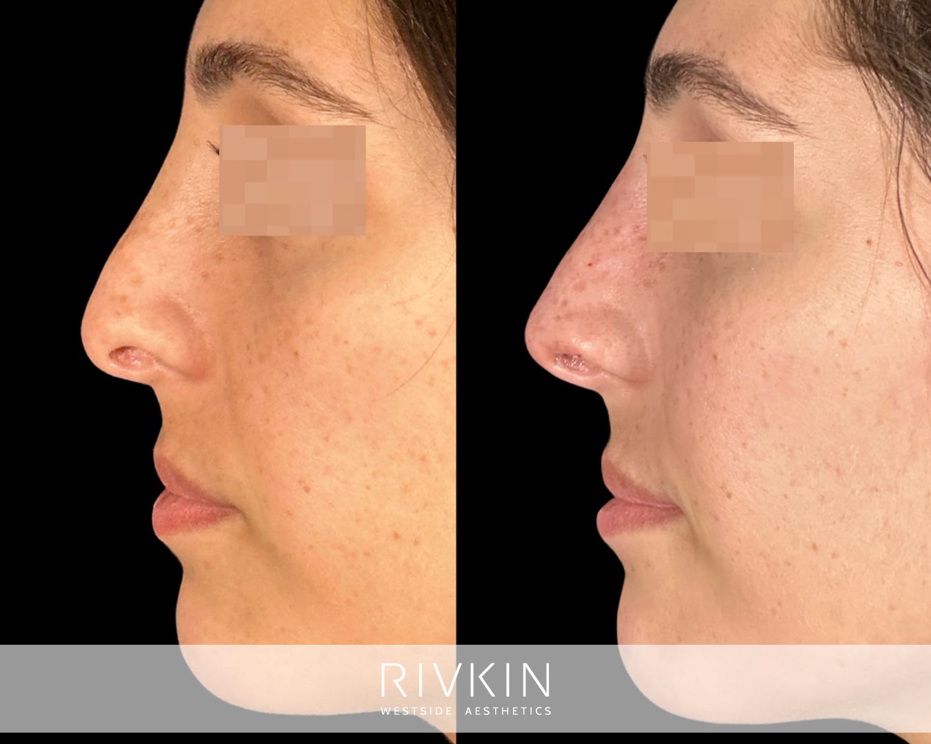 before and after rhinoplasty procedure