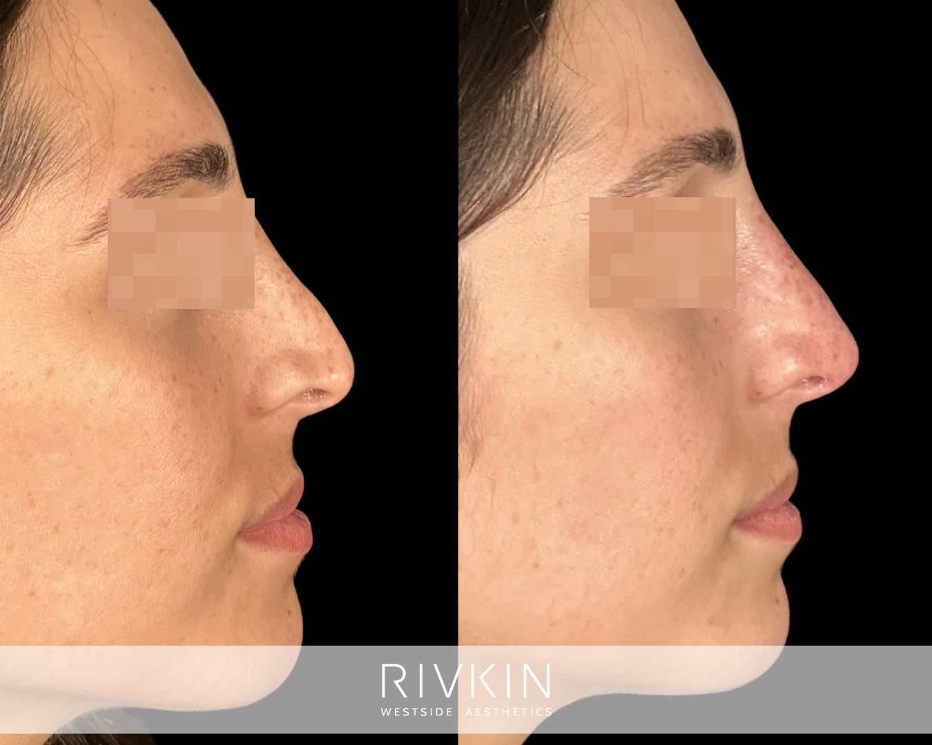 before and after rhinoplasty procedure