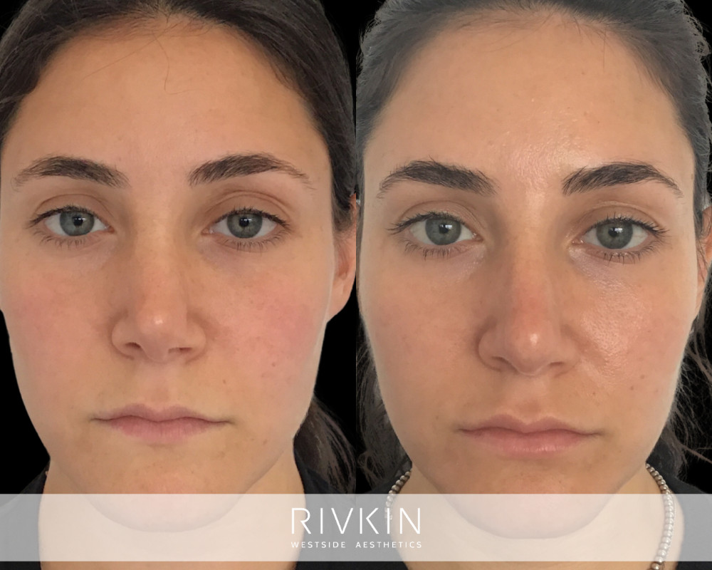 patient before and after revision rhinoplasty