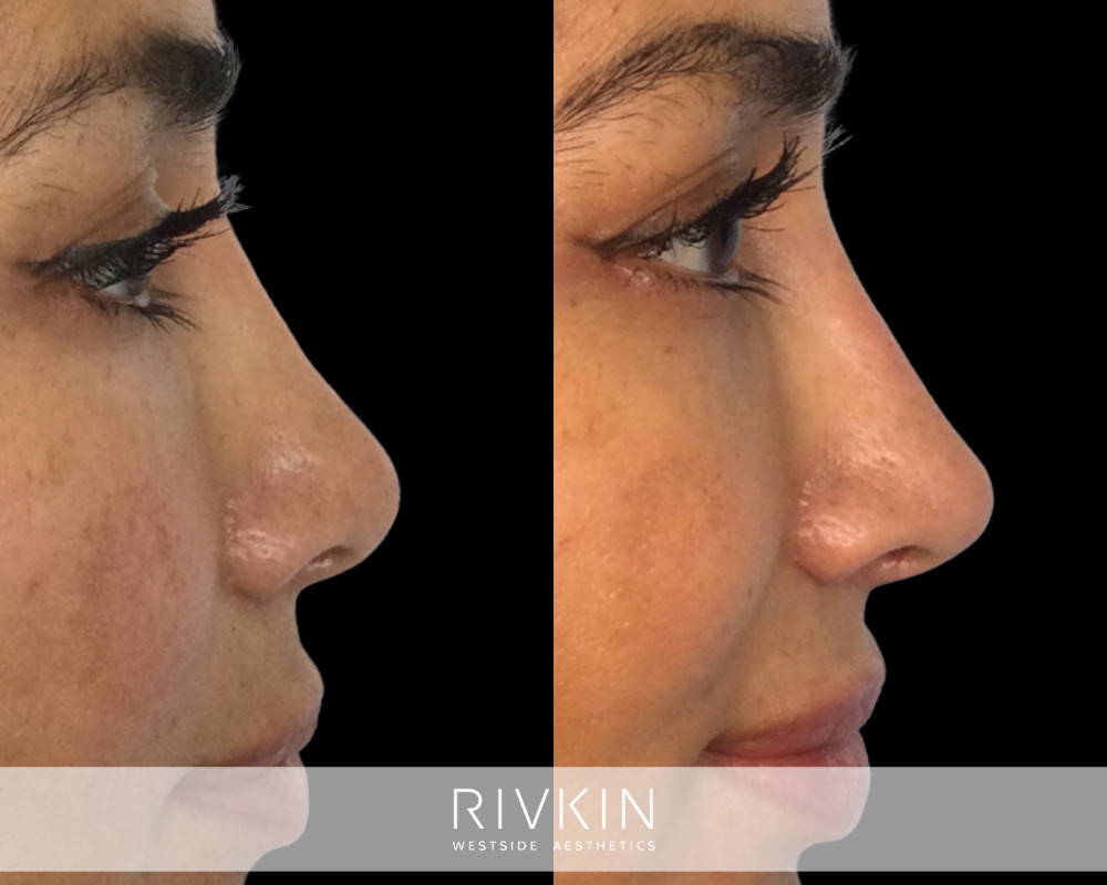 patient before and after revision rhinoplasty