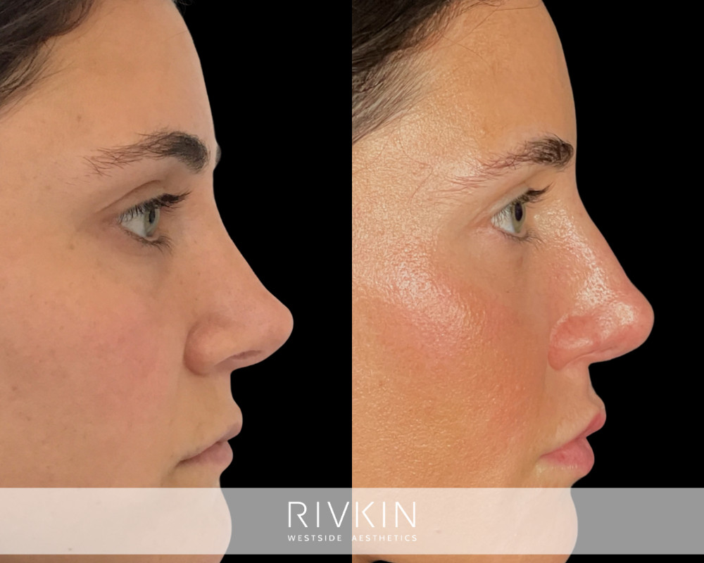 patient before and after revision rhinoplasty