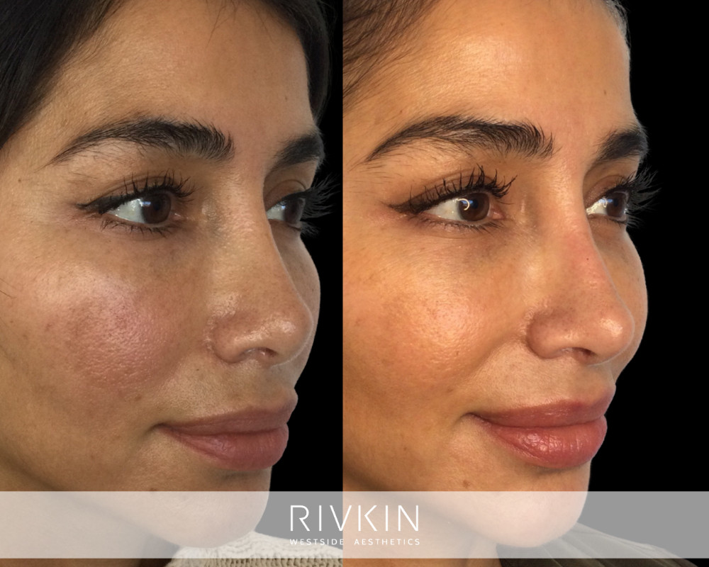 patient before and after revision rhinoplasty