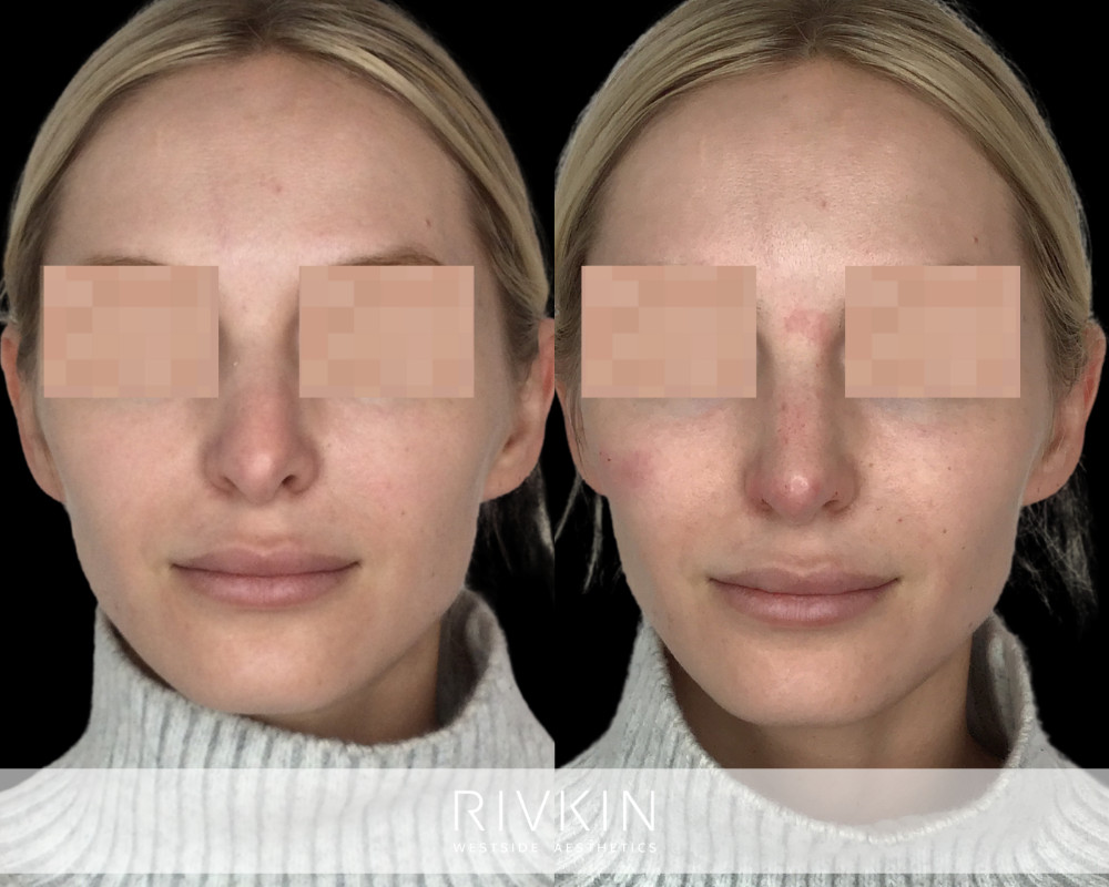 patient before and after revision rhinoplasty