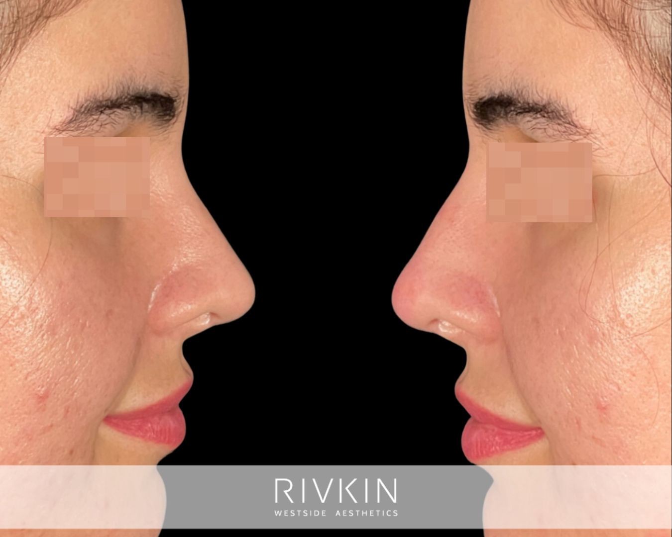 before and after surgical rhinoplasty