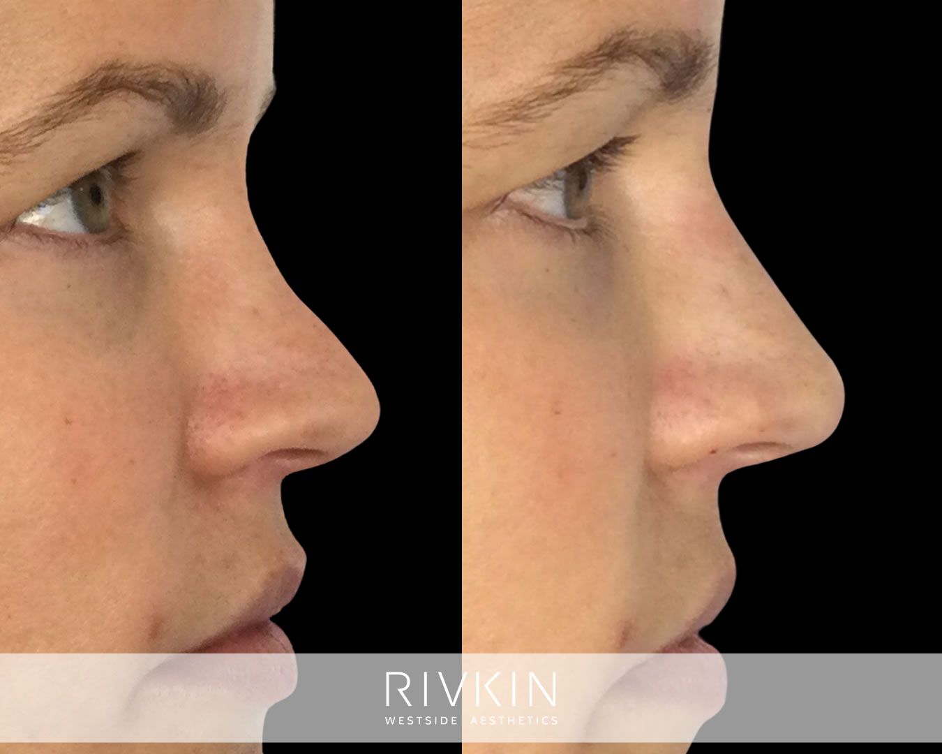 patient before and after scooped bridge procedure