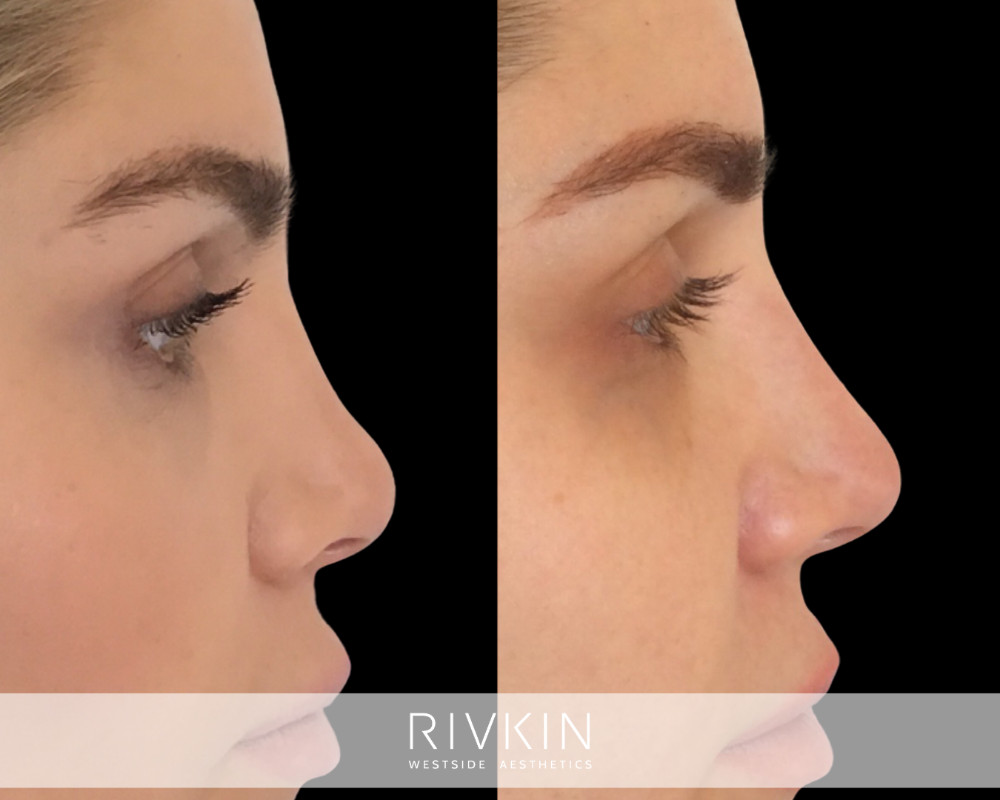 patient before and after revision rhinoplasty