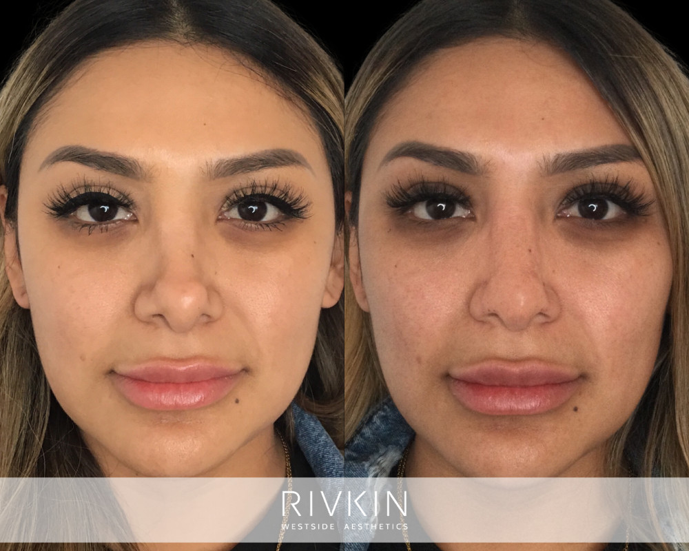 patient before and after revision rhinoplasty