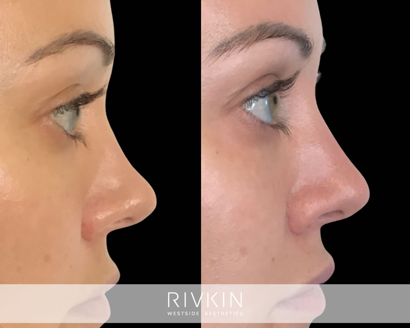 patient before and after scooped bridge procedure