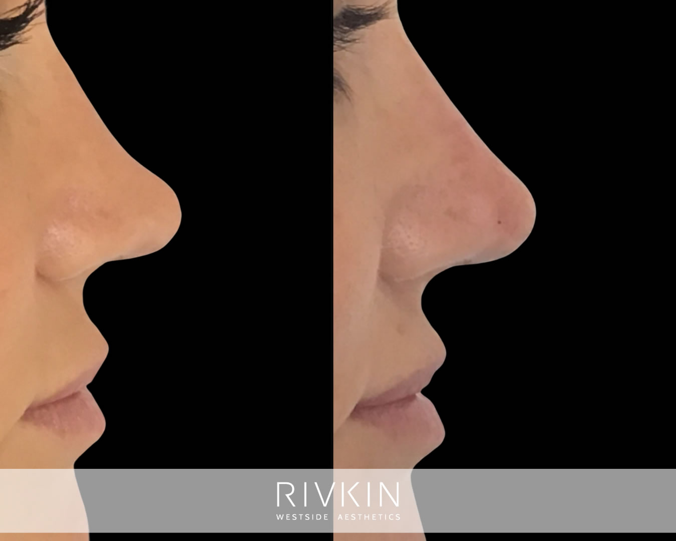 patient before and after scooped birdge procedure