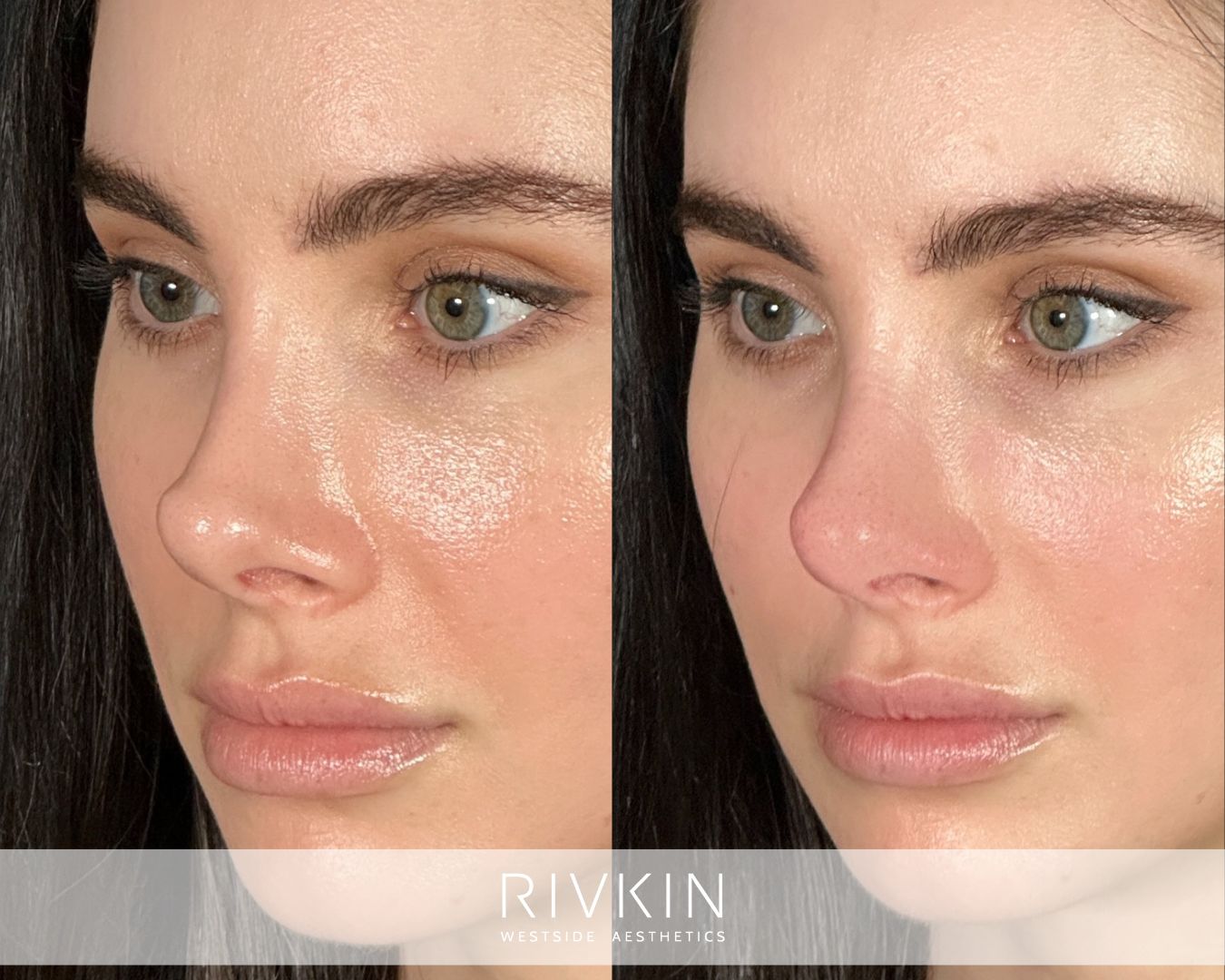 before and after surgical rhinoplasty