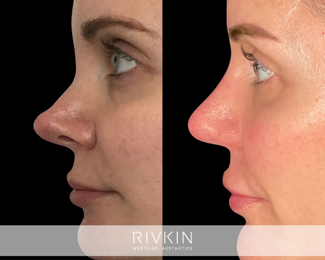 Before and after revision rhinoplasty