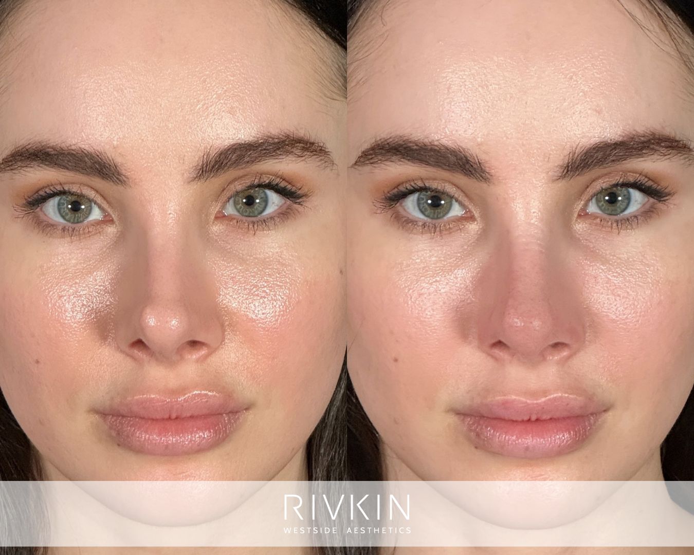 before and after surgical rhinoplasty